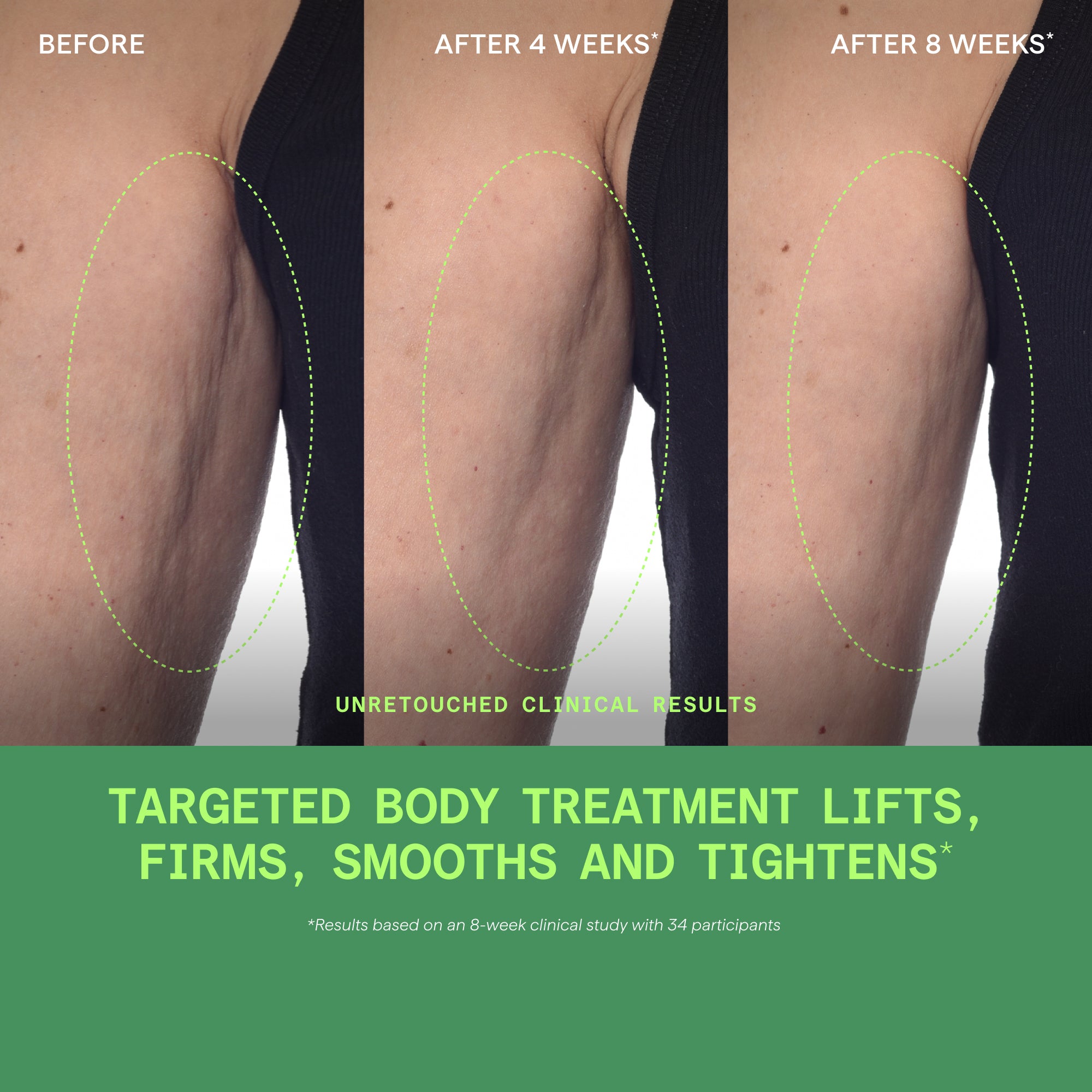 Three side-by-side images of a thigh showing progression at before, 4 weeks, and 8 weeks with dotted outline indicating treat
