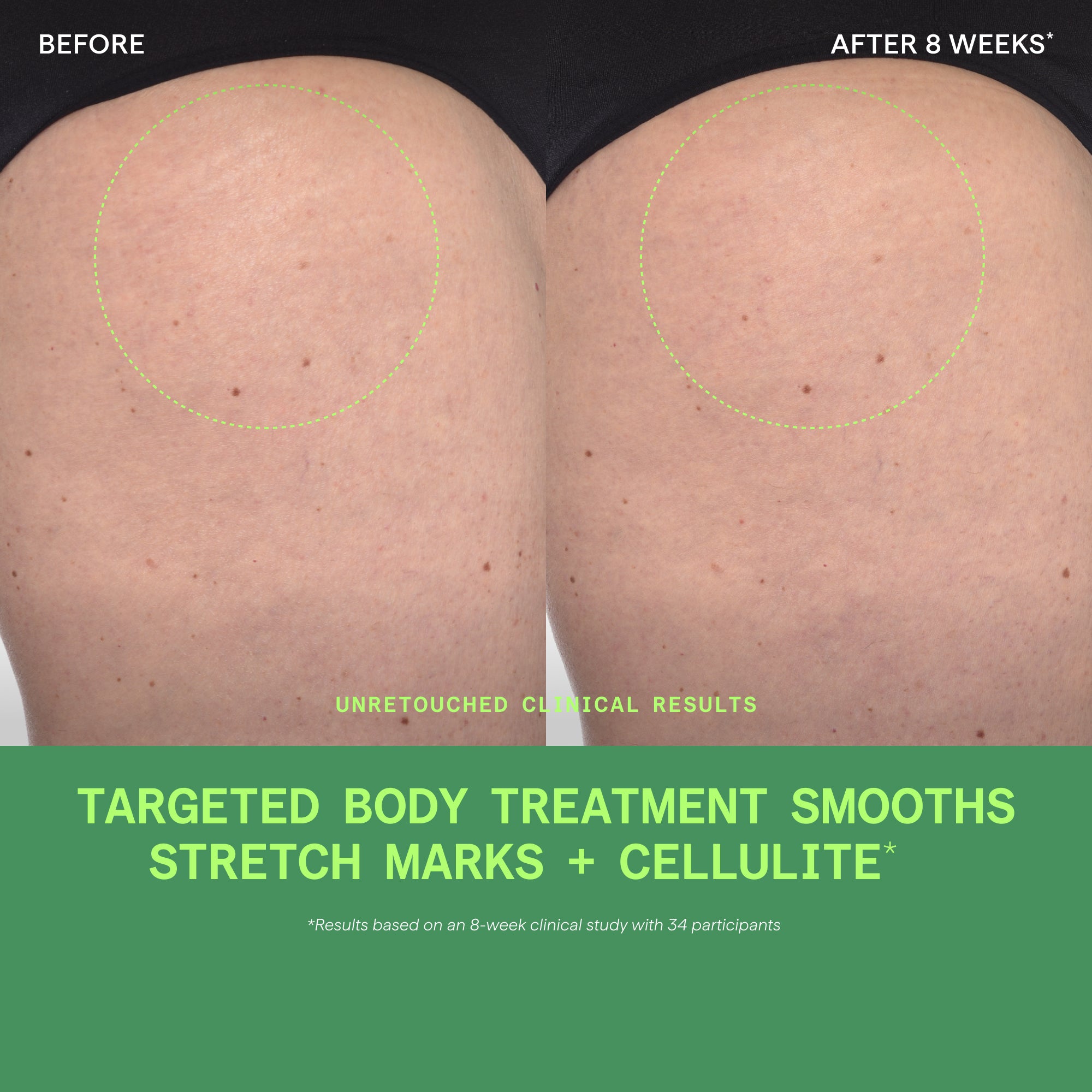 Before and after comparison of thigh skin showing reduced appearance of stretch marks and texture over 8 weeks.
