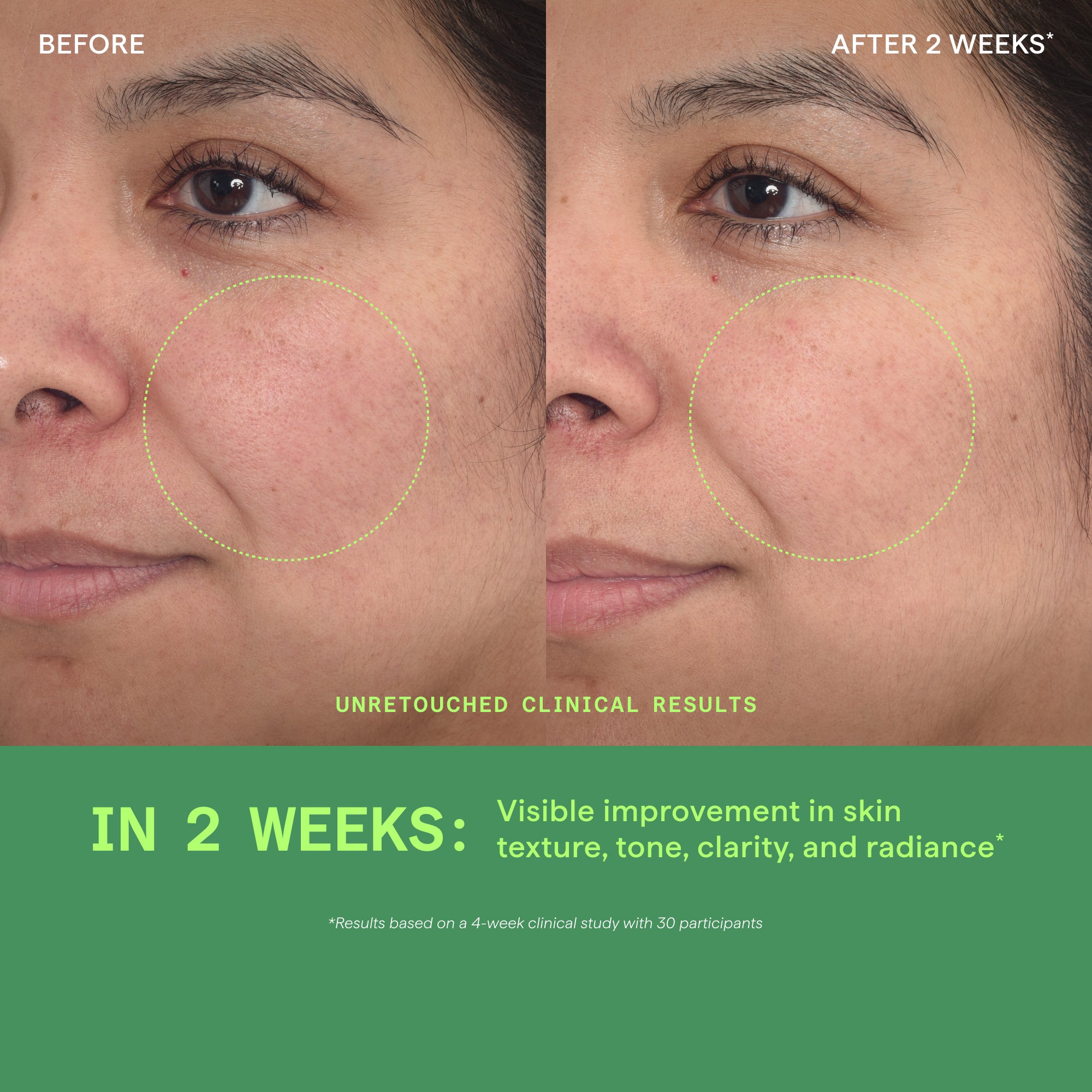 Before and after facial comparison showing skin texture and appearance of cheek area over two weeks.