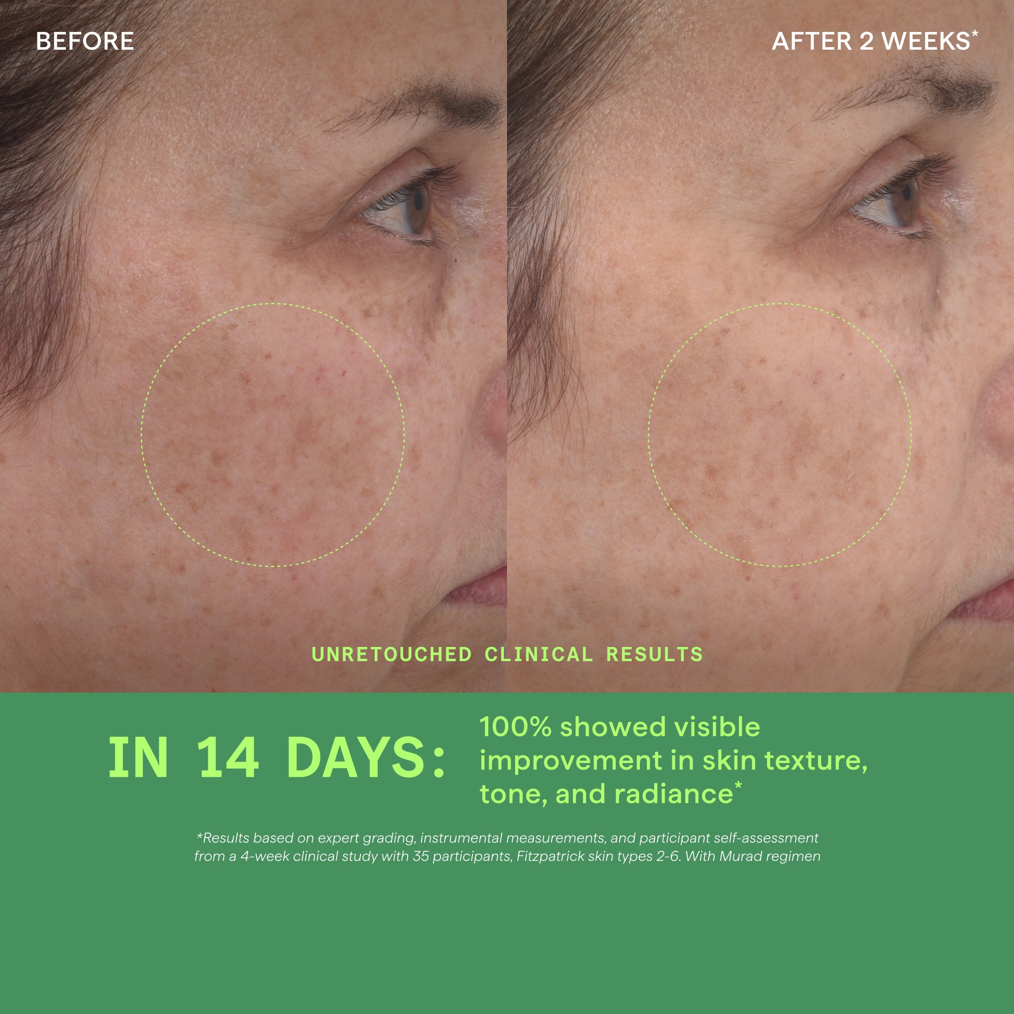 Before-and-after clinical skin comparison showing visible improvement in acne and skin texture on a person's cheek, with text reading 'BEFORE', 'AFTER 2 WEEKS*', 'IN 14 DAYS:', and 'UNRETouched Clinical Results' on a green footer.