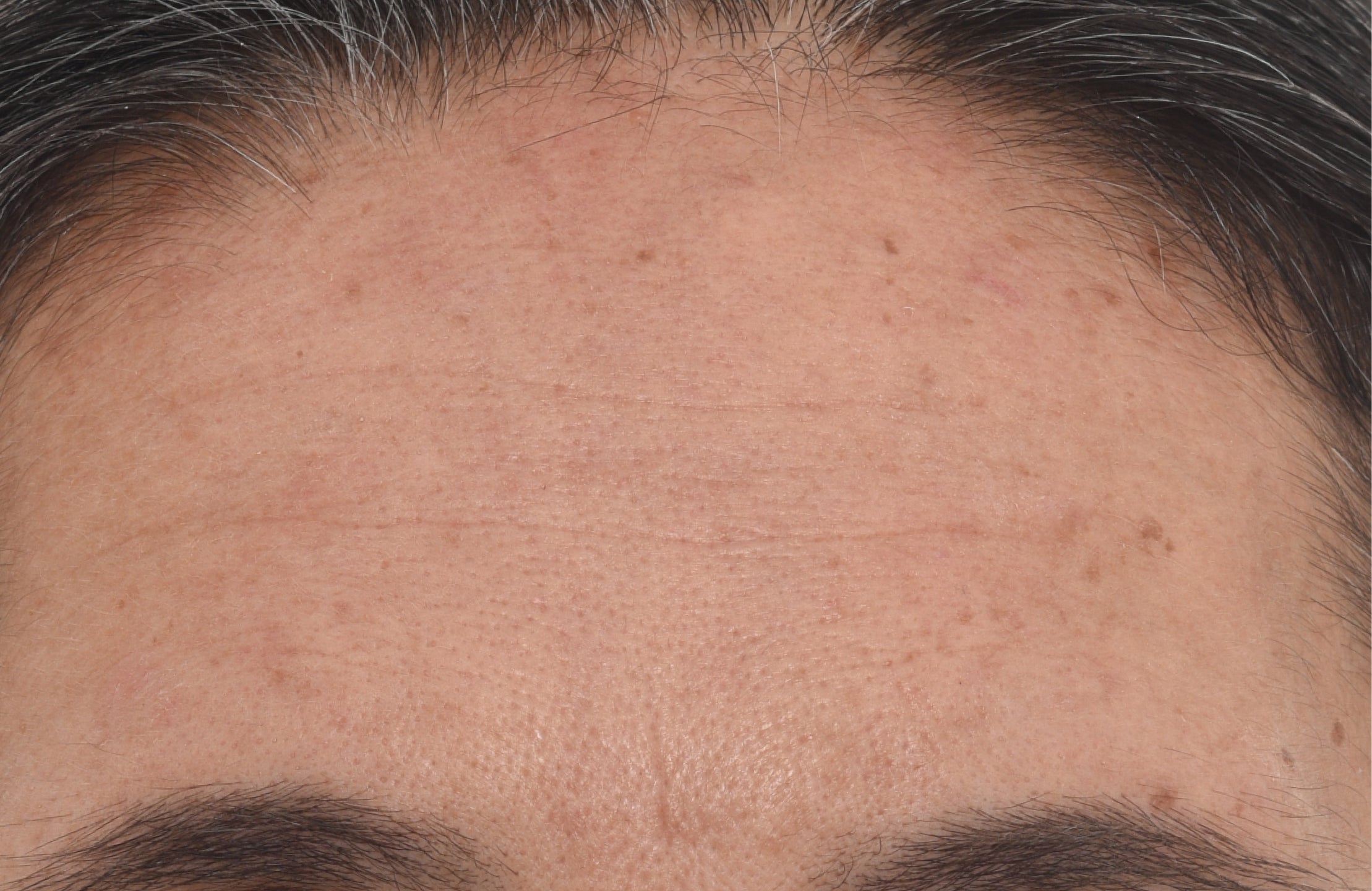 Close-up of a person's forehead showing skin texture, pores, and fine lines, with dark hair visible at the top and eyebrows at the bottom.