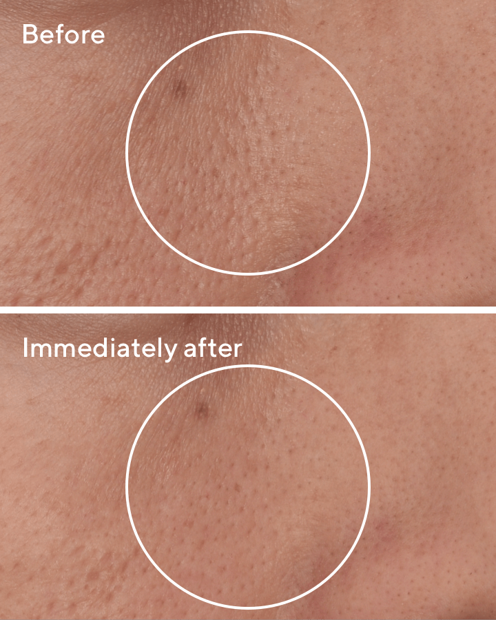 Targeted Pore Corrector B&A
